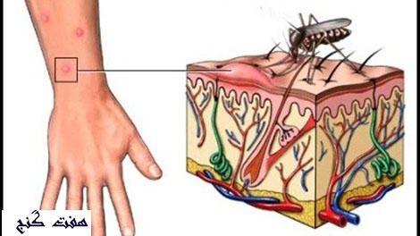 تب کریمه