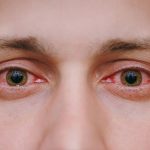 روش هایی ساده برای رفع قرمزی چشم