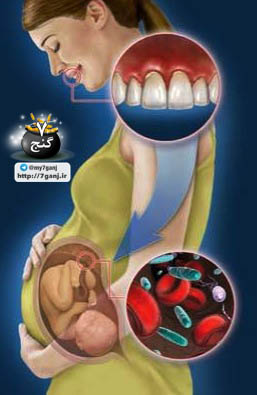 تاثیر سلامت دندان بر جنین