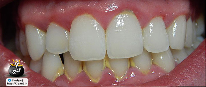 پلاک دندان