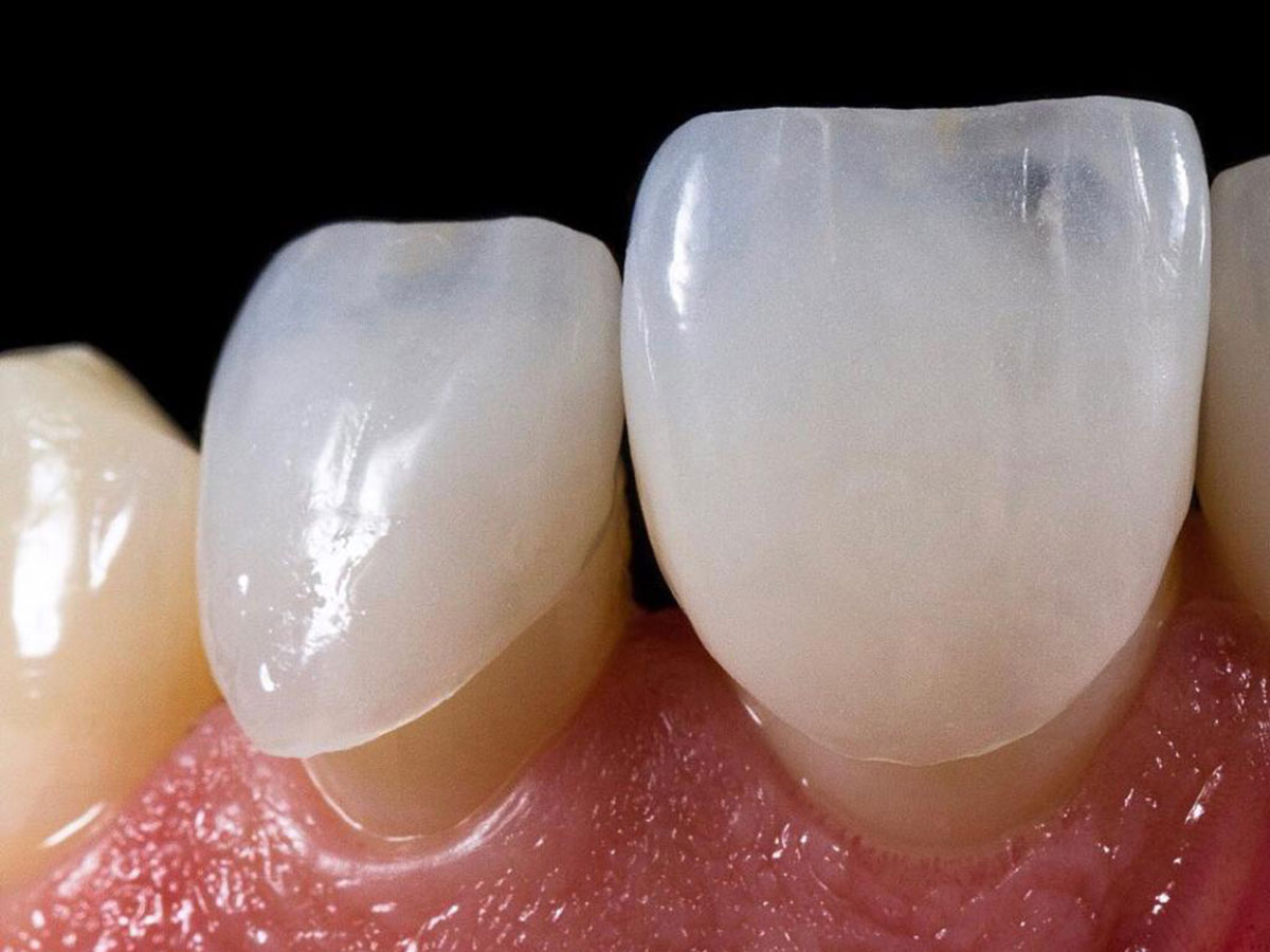 مزایای مینای دندان
