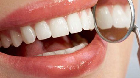 کامپوزیت دندان